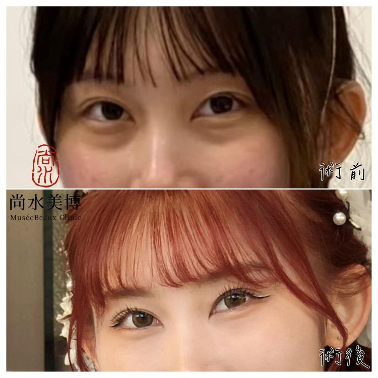眼袋手術術前術後對比。
