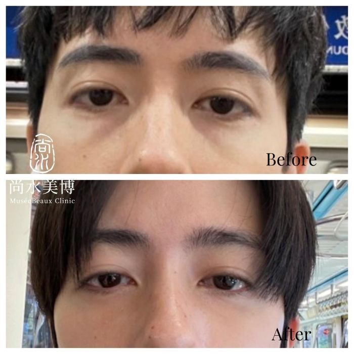 男性眼袋手術推薦|舒眠麻醉、快速復原、自然無痕