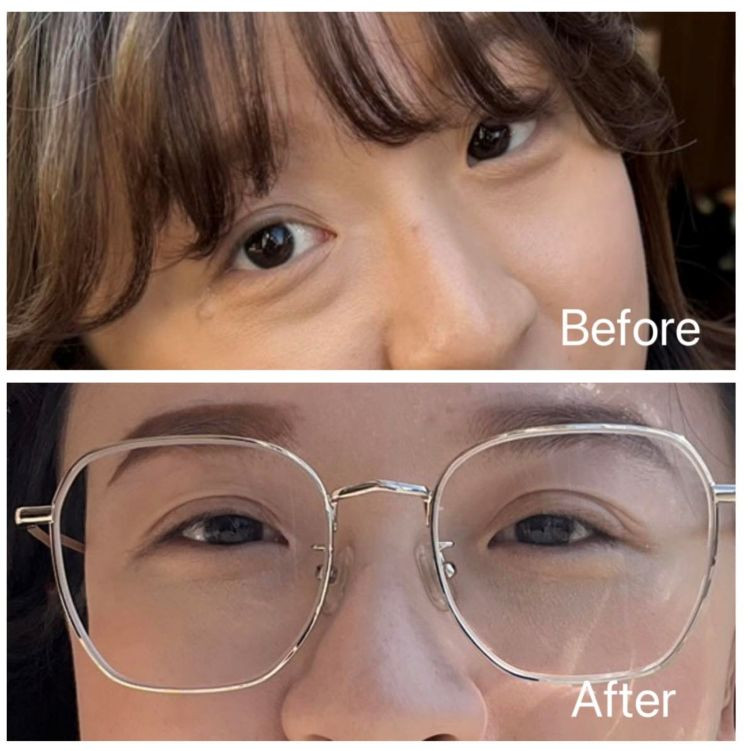 眼袋手術前後對比。