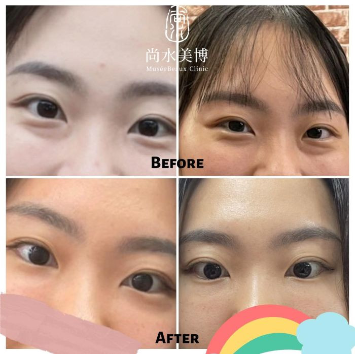 板橋眼袋手術心得。