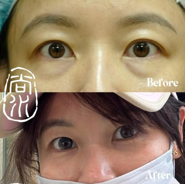 尚水美博眼袋手術術前術後對比。
