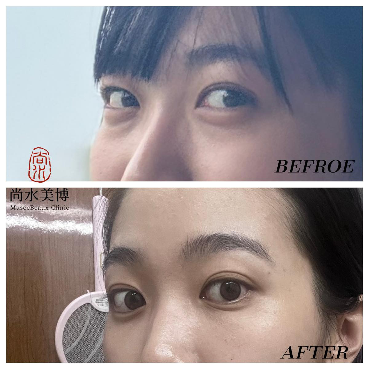 別再被問沒睡飽！眼袋手術真實分享：內開補脂拯救疲憊感，早做早享受