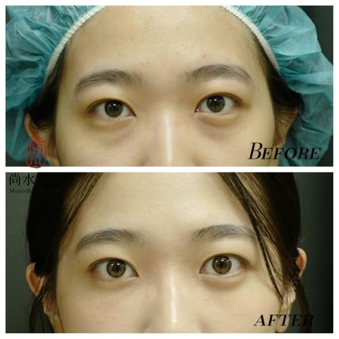 告別遺傳性眼袋：眼袋內開＋淚溝補脂，找回清爽自信神采