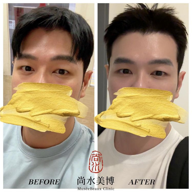 男士眼袋手術推薦 - 告別萬年疲憊感，重塑神采的自信投資