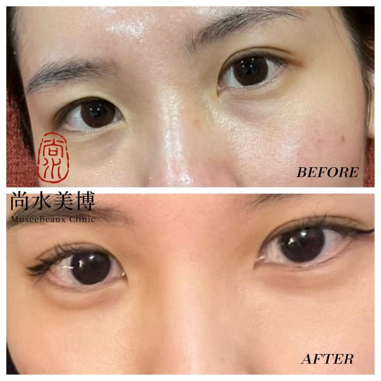 化妝也遮不住的眼袋淚溝？尚水美博眼袋手術心得分享，術後一個月真實紀錄