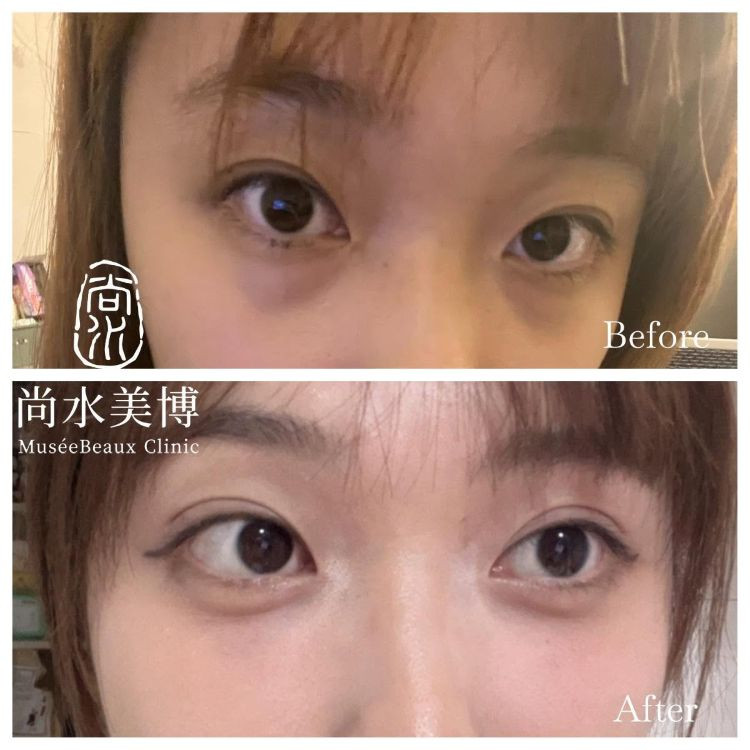 眼袋內開＋自體脂肪填補淚溝案例｜改善疲憊眼神，找回自然精神感