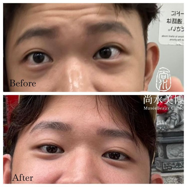 眼袋內開術後3個月真實心得！脂肪轉位填淚溝＋自體補脂，效果自然有精神